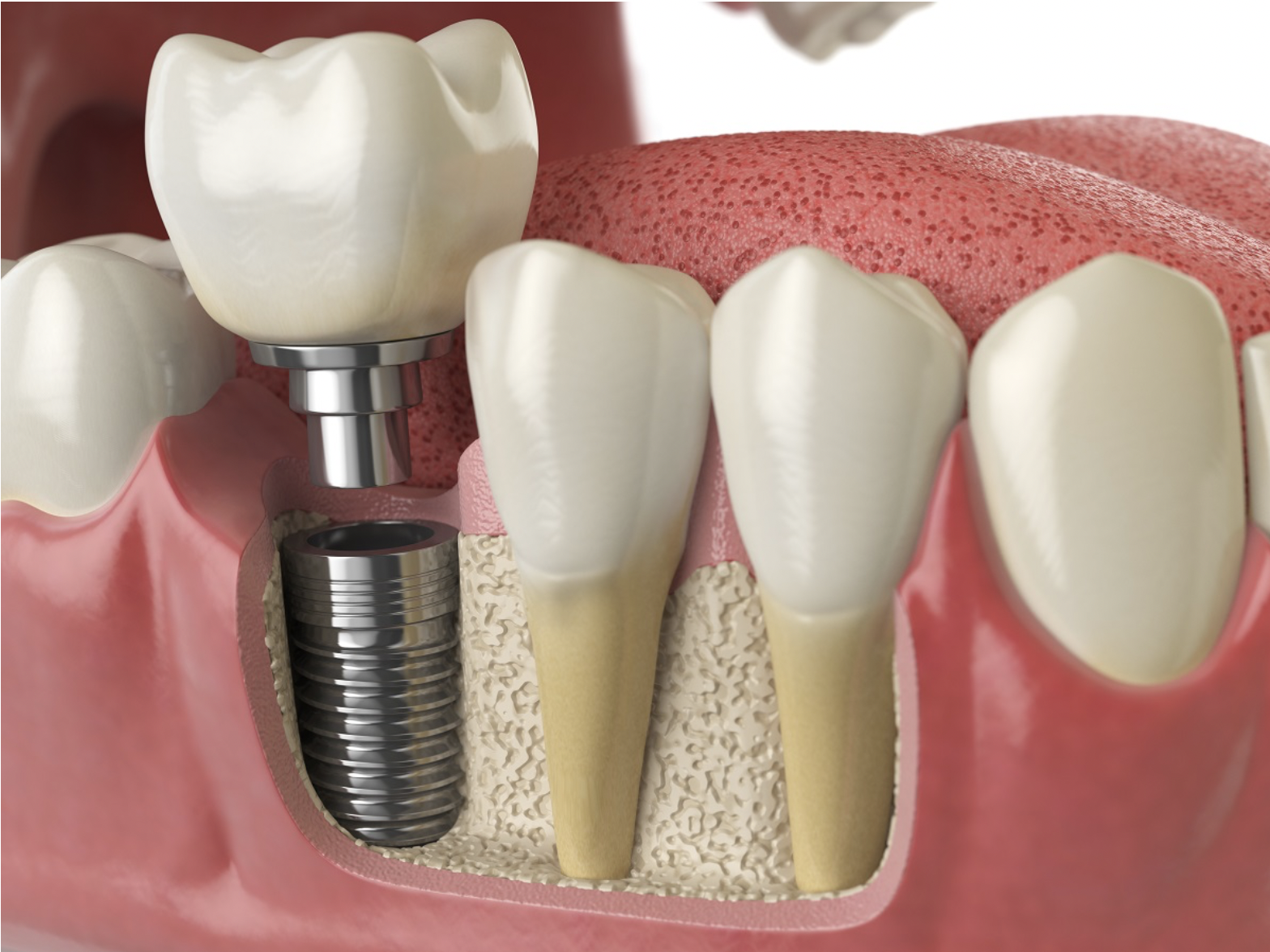 #implantedental #dentadura #drlucaportilho #dentistagoiania #dentistajardimamerica #clinicaodontologica #cirurgiaodentista