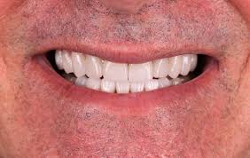 #implantedental #dentadura #drlucaportilho #dentistagoiania #dentistajardimamerica #clinicaodontologica #cirurgiaodentista